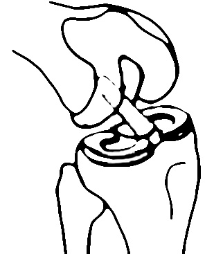 image vignette genou LCA DIDT KJ LEMAIRE TLS MAC FL  chirurgiedusport